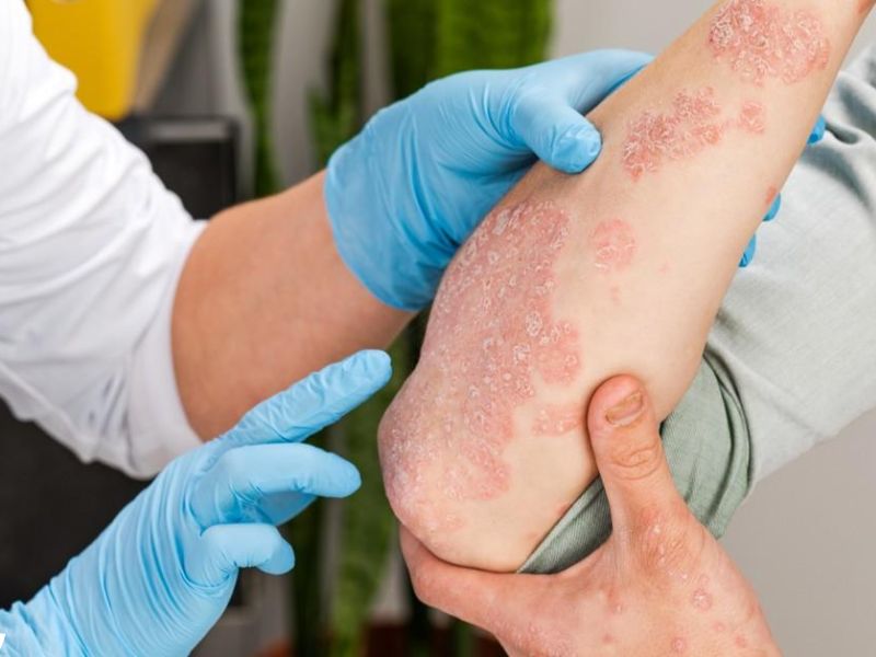 مركّب نباتي جديد يمنح أملاً علاجياً لمرضى الأكزيما العصبية