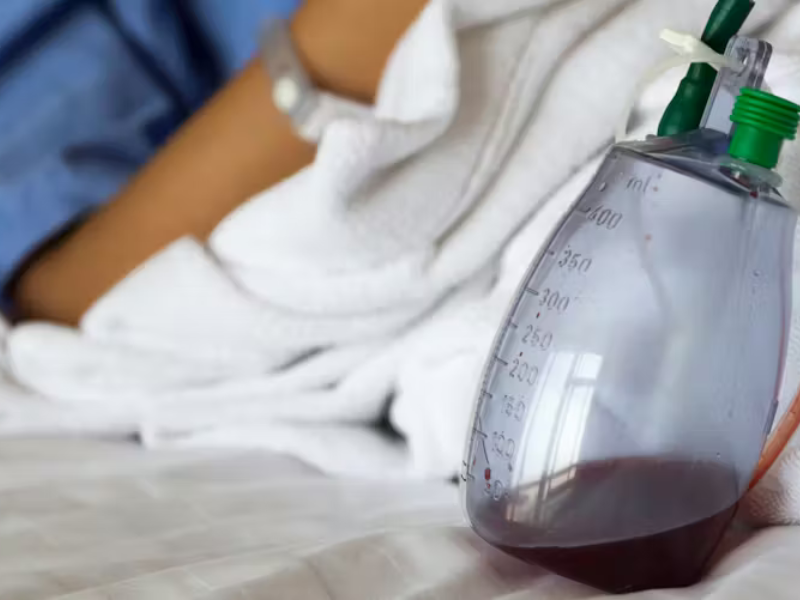 الدرين من نوع ريدون: دوره وكيفية العناية به بعد العمليات الجراحية