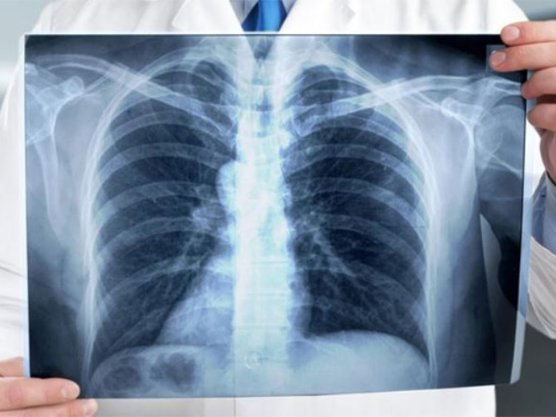 في اليوم العالمي للسل : 53% من الإصابات بالمغرب تصيب أعضاء الجسم خارج الرئتين