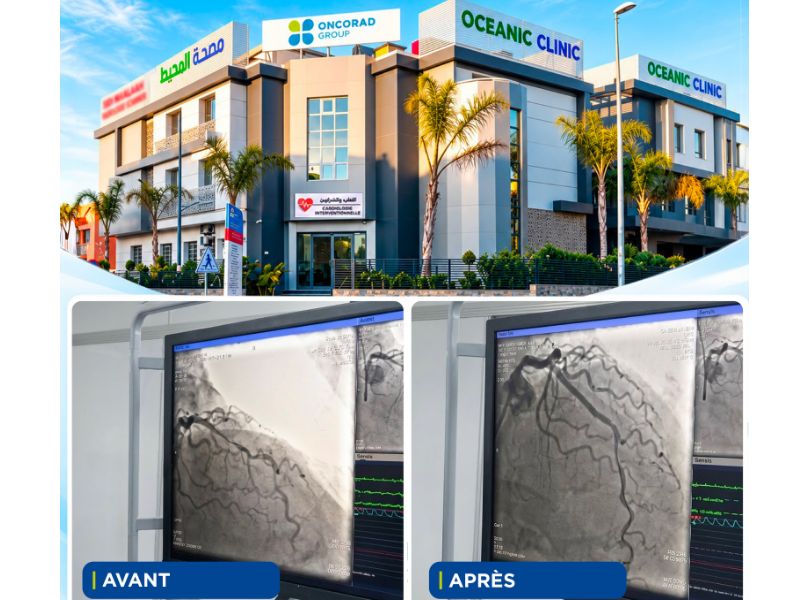 OceanicClinic El Hana تنجز تفتيتاً داخل الشريان التاجي لعلاج تكلسات شديدة لدى مريض فوق 70 عاماً