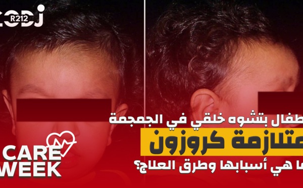 Care Week : أطفال بتشوه خلقي في الجمجمة، متلازمة كروزون،  ما هي أسبابها وطرق العلاج؟