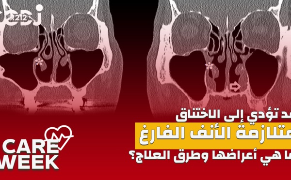 Care Week : قد تؤدي إلى الاختناق، متلازمة الأنف الفارغ، ما هي أعراضها وطرق العلاج؟