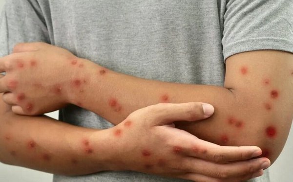 زيارات ميدانية للمجلس الوطني لحقوق الإنسان لتقييم تدابير مكافحة الحصبة في السجون