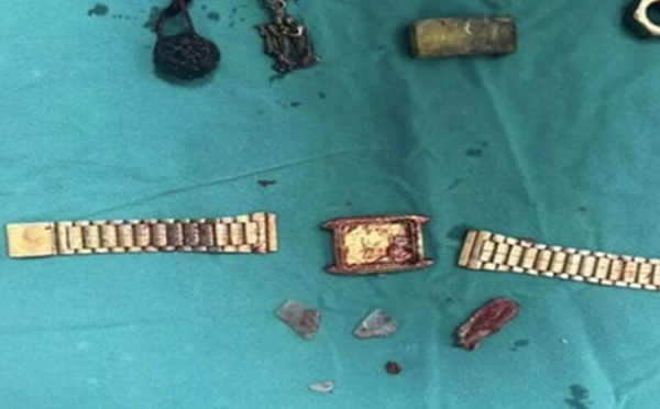 ساعات ومسامير وأقلام داخل المعدة: حوادث غريبة تكشف علاقة الاضطرابات النفسية بالسلوكيات الخطرة