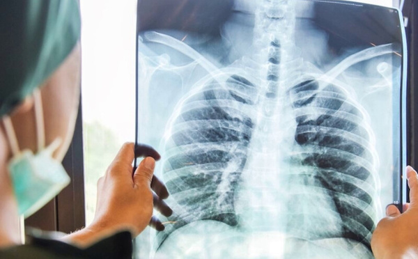 السل يتسبب في وفاة 1,23 مليون شخص خلال العام الماضي