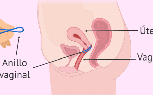 سقوط الحلقة المهبلية: ماذا تفعلين للحفاظ على فعاليتها؟