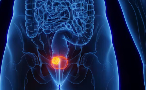 فيروس شائع قد يكون سبباً في سرطان المثانة: اكتشاف واعد