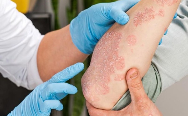 مركّب نباتي جديد يمنح أملاً علاجياً لمرضى الأكزيما العصبية