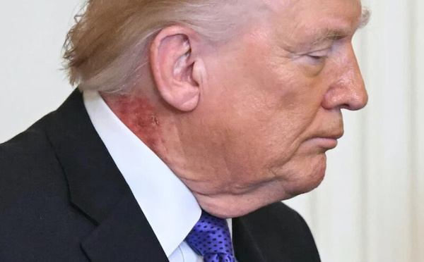 طفح جلدي على رقبة ترامب يثير تساؤلات… والطبيب يوضح