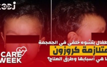 Care Week : أطفال بتشوه خلقي في الجمجمة، متلازمة كروزون،  ما هي أسبابها وطرق العلاج؟