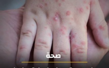  عاجل وفاة طفلين ب"بوحمرون"