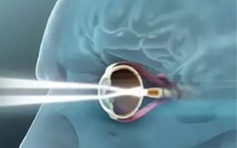 عين إلكترونية جديدة تمنح فاقدي البصر القدرة على القراءة مجددًا