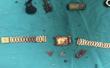 ساعات ومسامير وأقلام داخل المعدة: حوادث غريبة تكشف علاقة الاضطرابات النفسية بالسلوكيات الخطرة