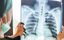 السل يتسبب في وفاة 1,23 مليون شخص خلال العام الماضي