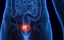 فيروس شائع قد يكون سبباً في سرطان المثانة: اكتشاف واعد