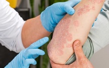 مركّب نباتي جديد يمنح أملاً علاجياً لمرضى الأكزيما العصبية